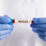 Ratusan Warga Brebes Suspek Campak, 4 Dinyatakan Positif