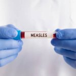 Kemenkes Sebut Campak adalah Penyakit Paling Menular