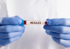 Kemenkes Sebut Campak adalah Penyakit Paling Menular