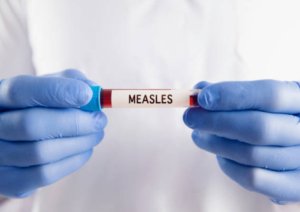 Ratusan Warga Brebes Suspek Campak, 4 Dinyatakan Positif